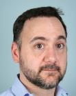 After Hair Transplant&nbsp;Front